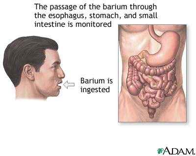 Barium ingestion