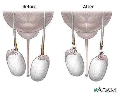 Before and after vasectomy