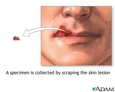 Viral lesion culture