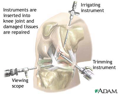 Arthroscopy