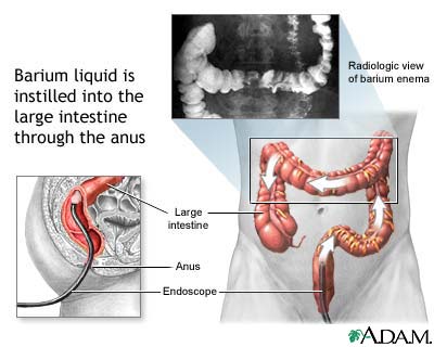 Barium enema