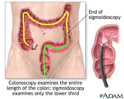 Colonoscopy