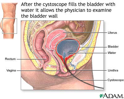 Cystoscopy