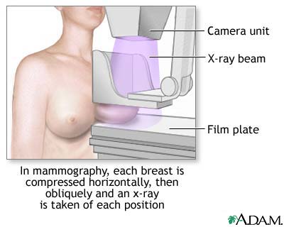 Mammography