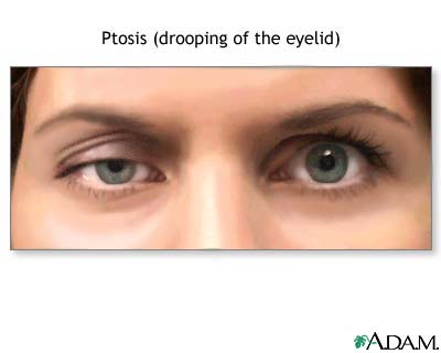 Ptosis, drooping of the eyelid