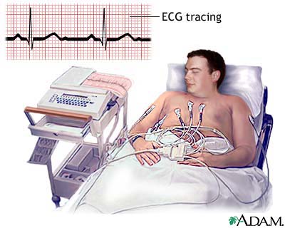 ECG