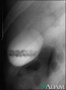 Gallstones, cholangiogram