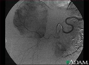 Hemangioma - angiogram