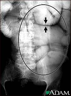 Ileus - X-ray of bowel distension