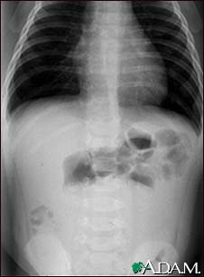 Intussusception - X-ray