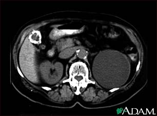 Kidney cyst with gallstones, CT scan