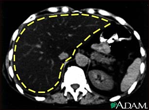 Liver fattening, CT scan