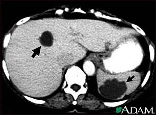 Liver and spleen cysts - CT scan