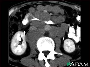 Lymphoma, malignant - CT scan