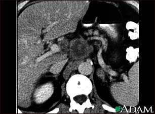 Pancreatic cancer, CT scan