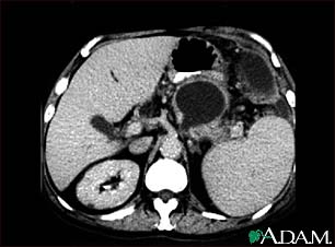 Pancreatic pseudocyst, CT scan