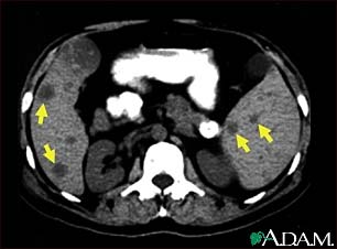 Spleen metastasis - CT scan