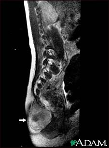 Teratoma - MRI scan