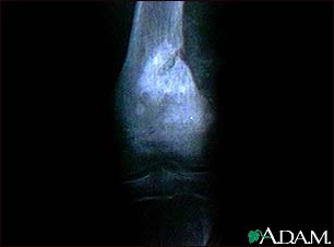 Osteogenic sarcoma - X-ray