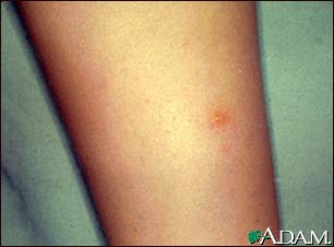 Chickenpox - lesion on the leg