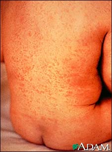 Rubella on an infant's back