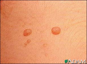 Molluscum contagiosum - close-up