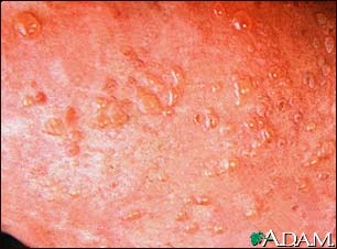 Dermatitis, herpetiformis - close-up of lesion