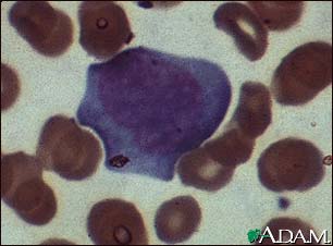 Mononucleosis, photomicrograph of cells