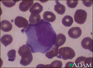 Infectious Mononucleosis #3