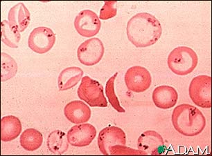 Red blood cells, sickle and pappenheimer