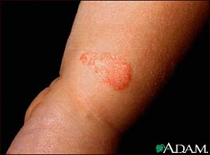 Ringworm, tinea corporis on an infant's leg