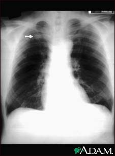 Pulmonary nodule - front view chest X-ray