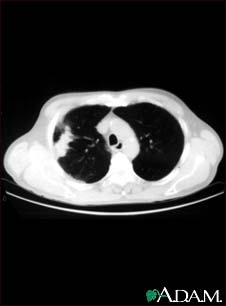 Lung with squamous cell cancer - CT scan