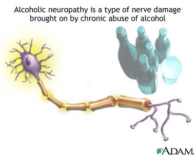 Alcoholic neuropathy