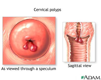 Cervical polyps