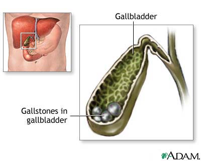 Cholelithiasis