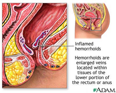 Hemorrhoids