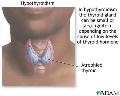 Hypothyroidism