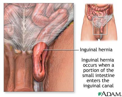 Inguinal hernia