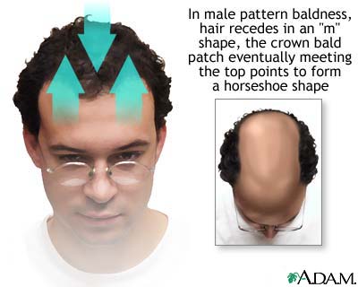 Male pattern baldness