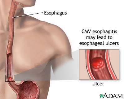 CMV esophagitis