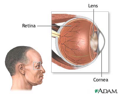 CMV retinitis