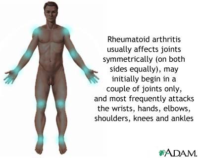 Rheumatoid arthritis