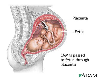 Congenital cytomagalovirus