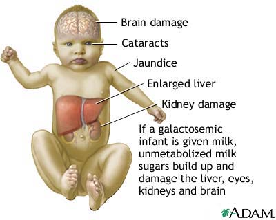 Galactosemia