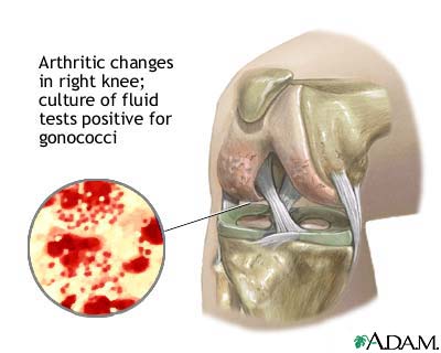 Gonoccocal arthritis