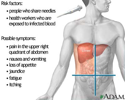 Hepatitis C