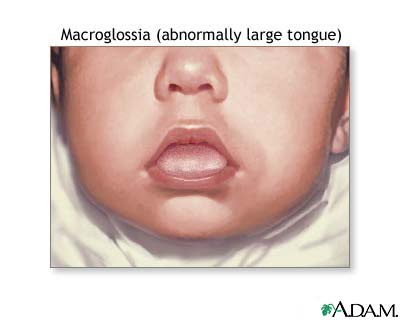 Macroglossia