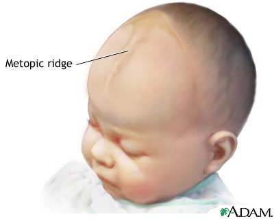 Metopic ridge