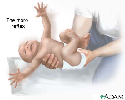 Moro reflex